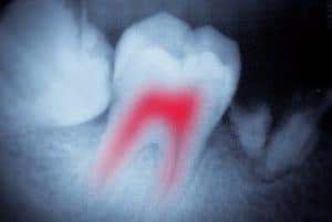 5 Mistakes to Avoid When a Tooth Hurts Buffalo Root Canal Dentist