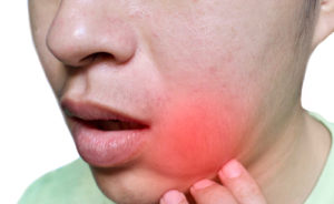 Abscessed Teeth Tooth Infection Treatment Buffalo Root Canal Dentist