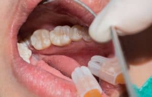 Apexification Therapy