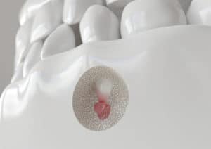 Common Root Canal Concerns Endodontist in Buffalo, NY
