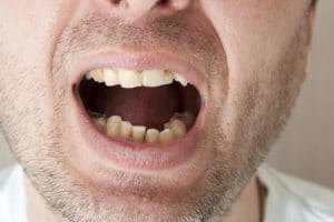 Good Root Canal Candidate