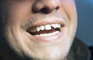 Treating Traumatic Tooth Injuries