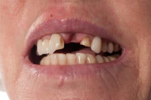 Dislodged Tooth | Precision Endodontics | Tooth Trauma