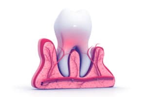 Tips to Avoid Root Canal Treatment | Precision Endodontics, PC | Buffalo